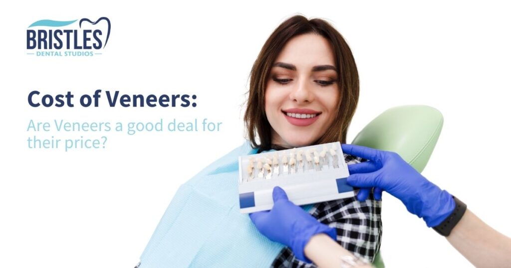 How much do Veneer Cost? All about Teeth Veneer Price: Exactly How much for Veneers?