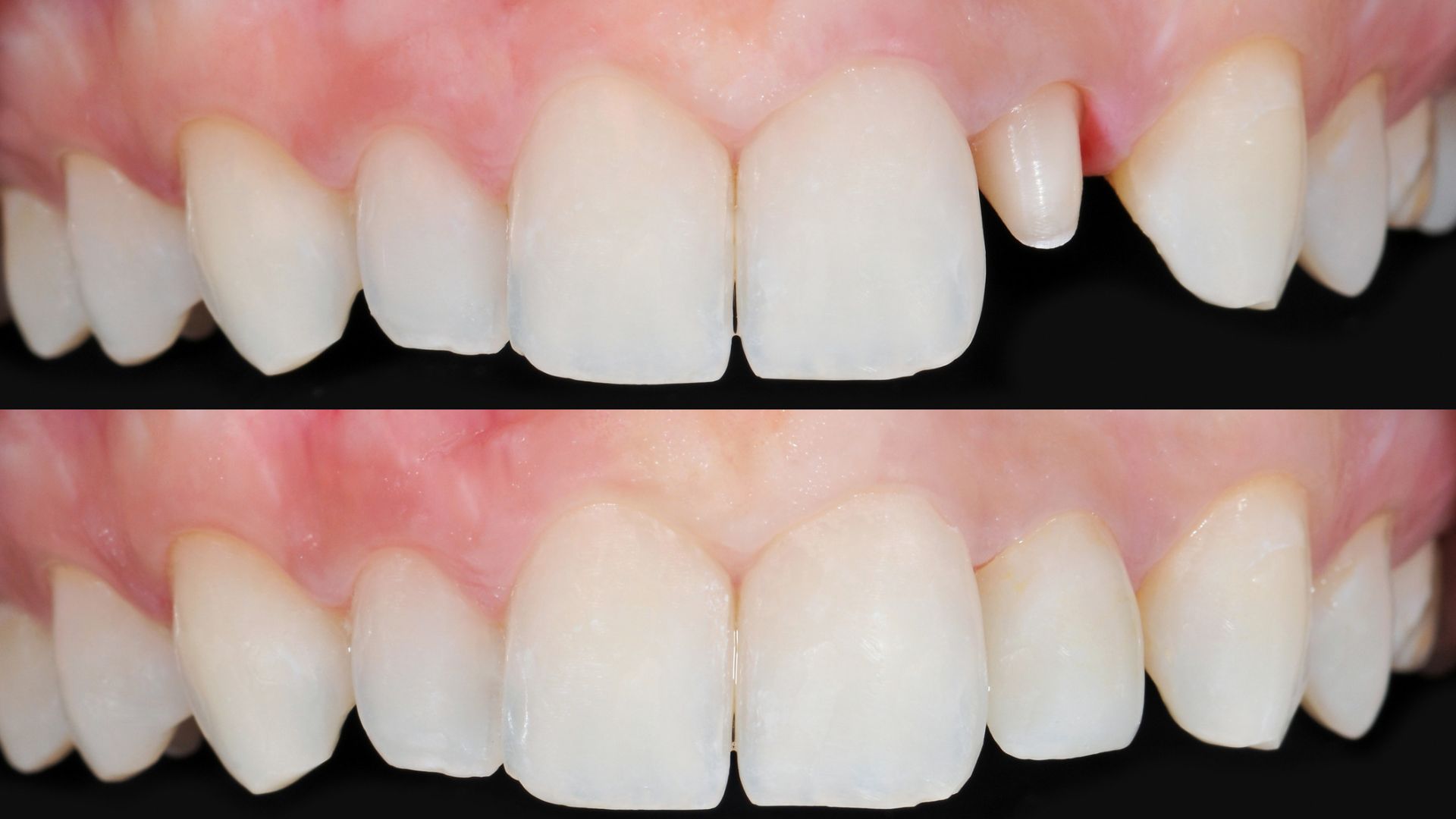 before and after Dental Crown and Bridges in Chandigarh