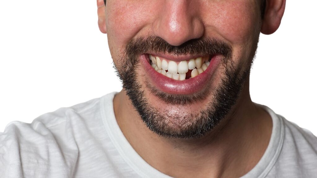 missing lower teeth of young man came to bristles dental studios for dental implants treatment
