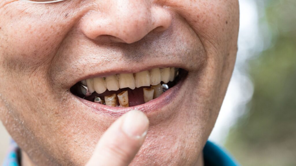 old man showing missing teeth and the use of dental implants in chandigarh