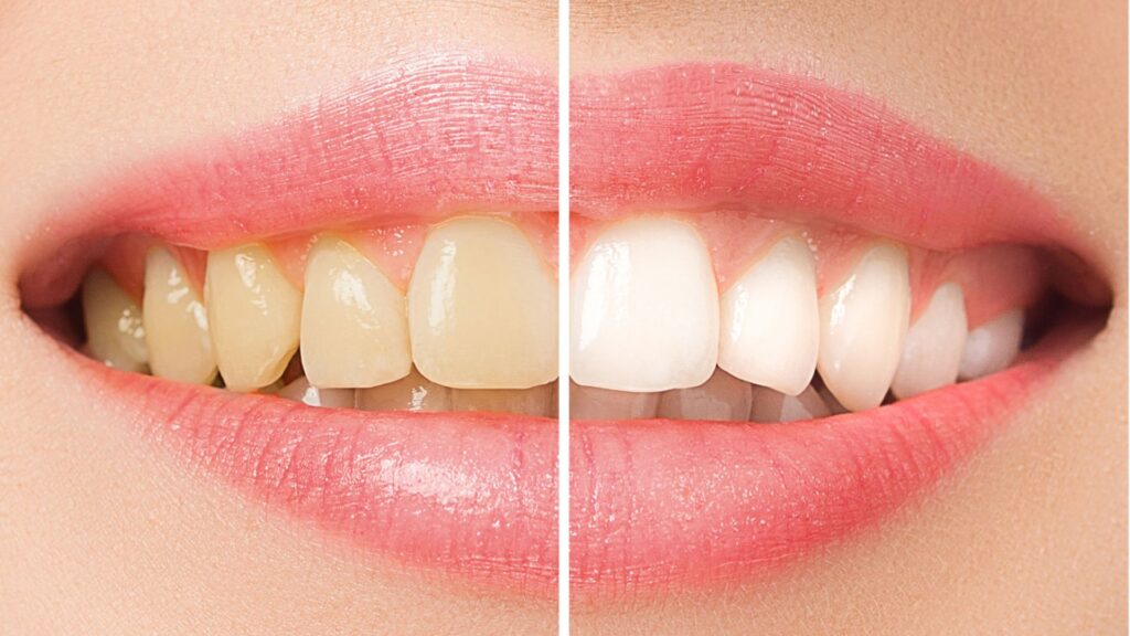 before and after image for teeth whitening in chandigarh