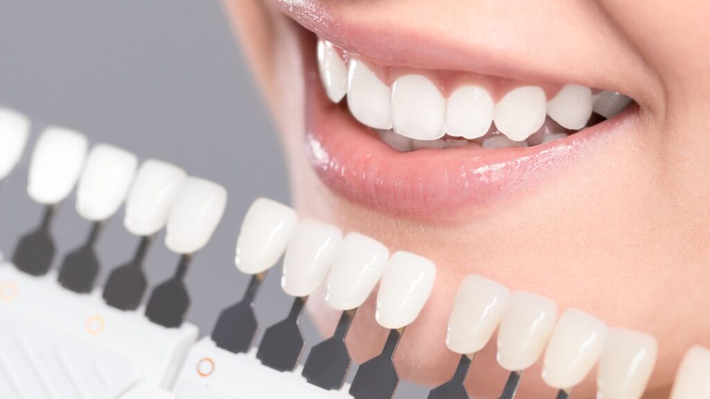 shade matching for teeth whitening in chandigarh