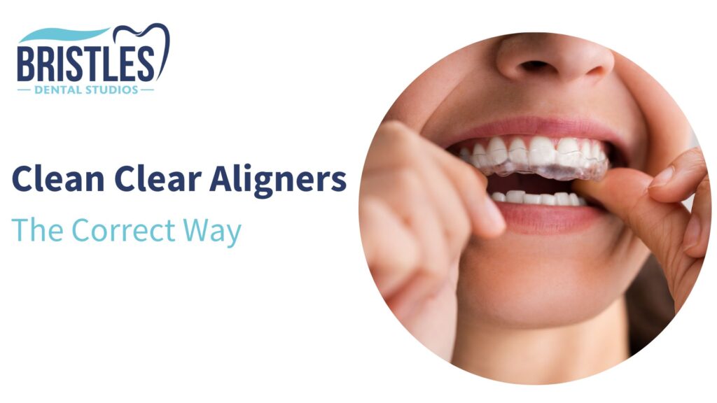 Effective ways to clean your clear aligners at home: general tips to keep them safe