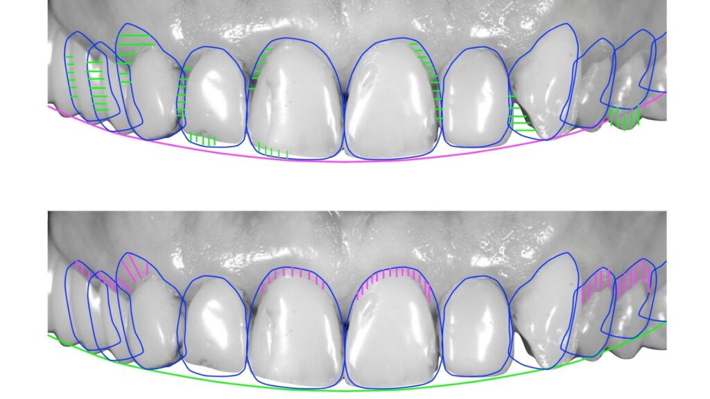 image showing computerised 3d Smile Makeover in Chandigarh