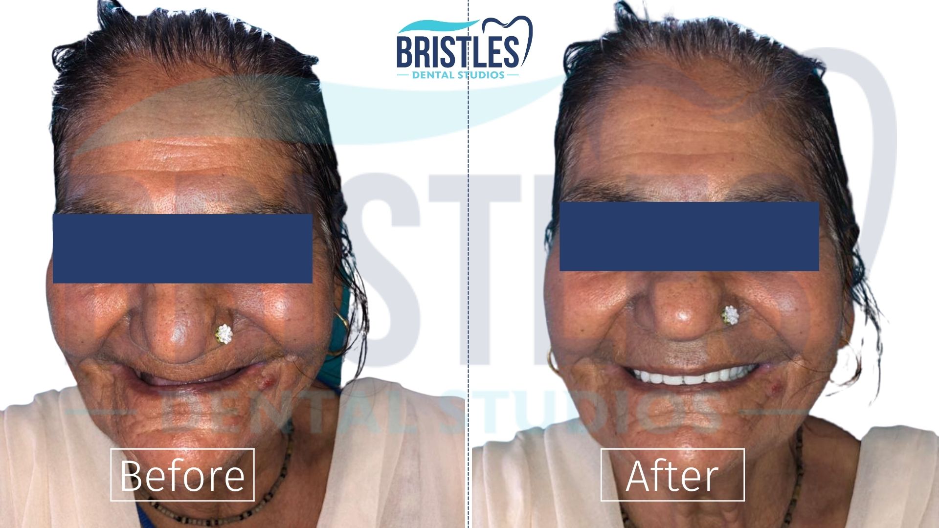 complete-dentures-case-before-after
