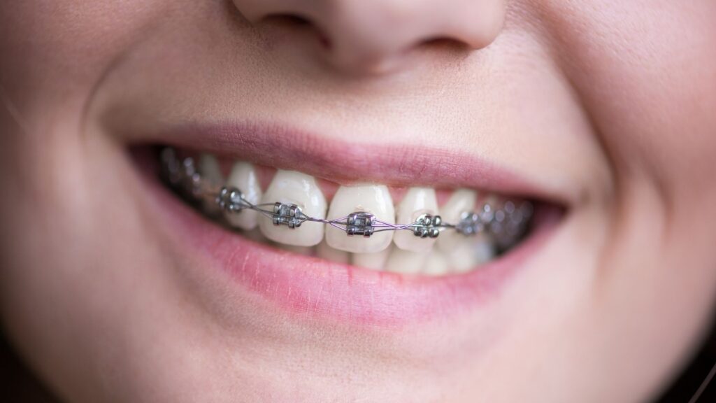 braces in chandigarh