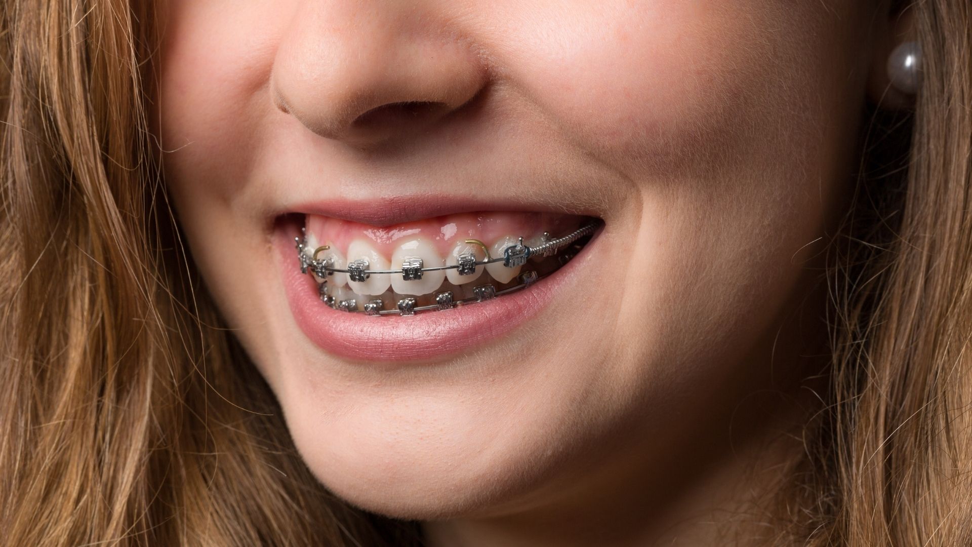 dental-braces-in-chandigarh2 dental braces in chandigarh - orthodontist in chandigarh, preventive braces treatment in chandigarh