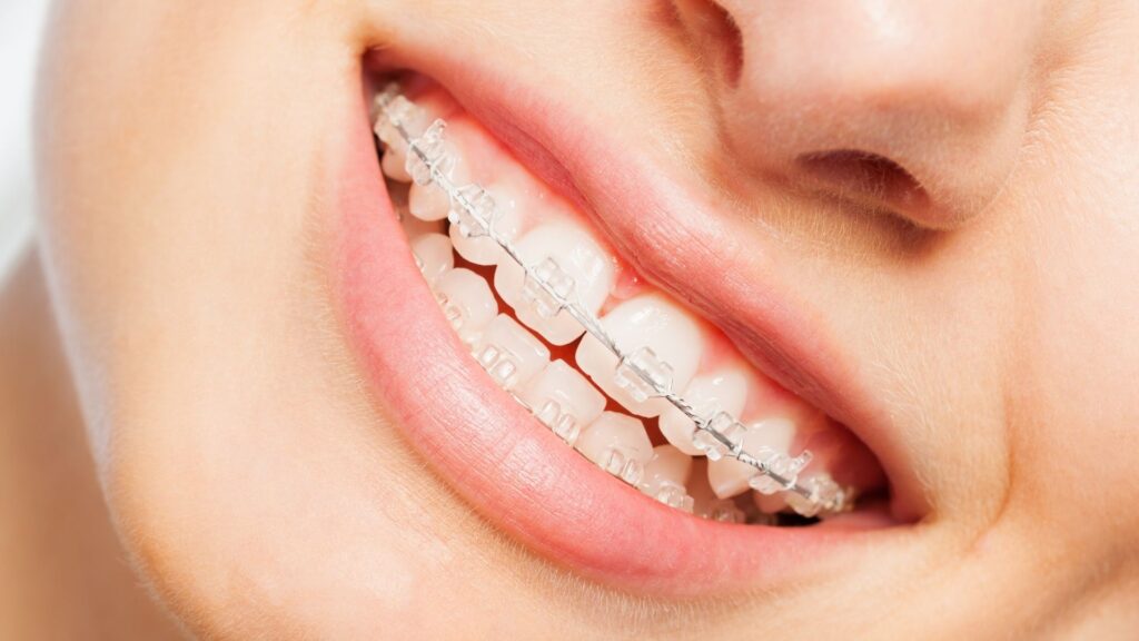 dental braces in chandigarh - orthodontist in chandigarh, tooth colored braces in chandigarh