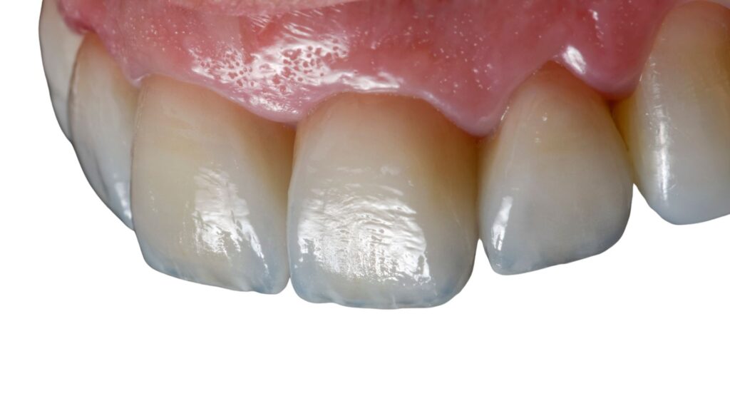 clinical picture of dental veneers in chandigarh after these were applied to patient's teeth