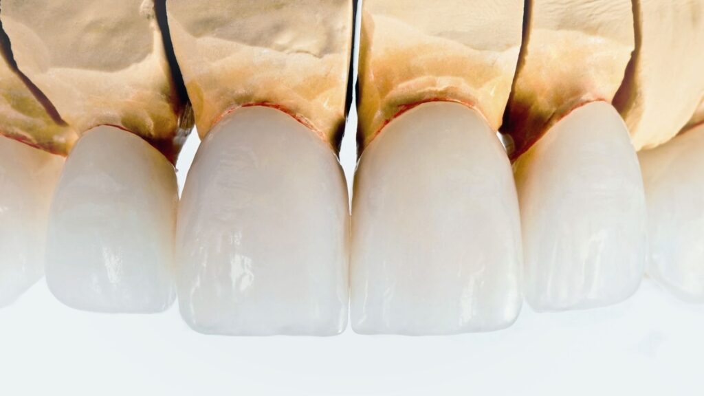 lab image for dental veneers in chandigarh