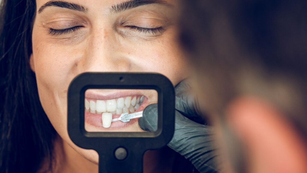 a patient for dental veneers in chandigarh