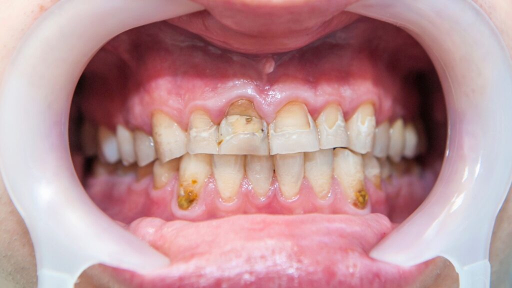 man with severely attrited teeth Full Mouth Rehabilitation in Chandigarh