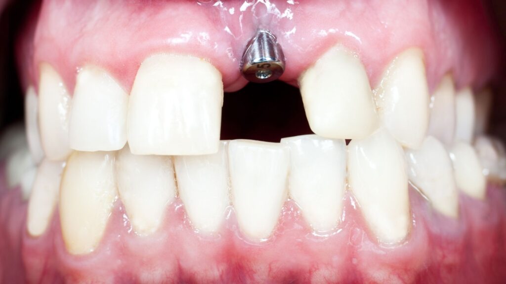 an image with dental implant placement Full Mouth Rehabilitation in Chandigarh