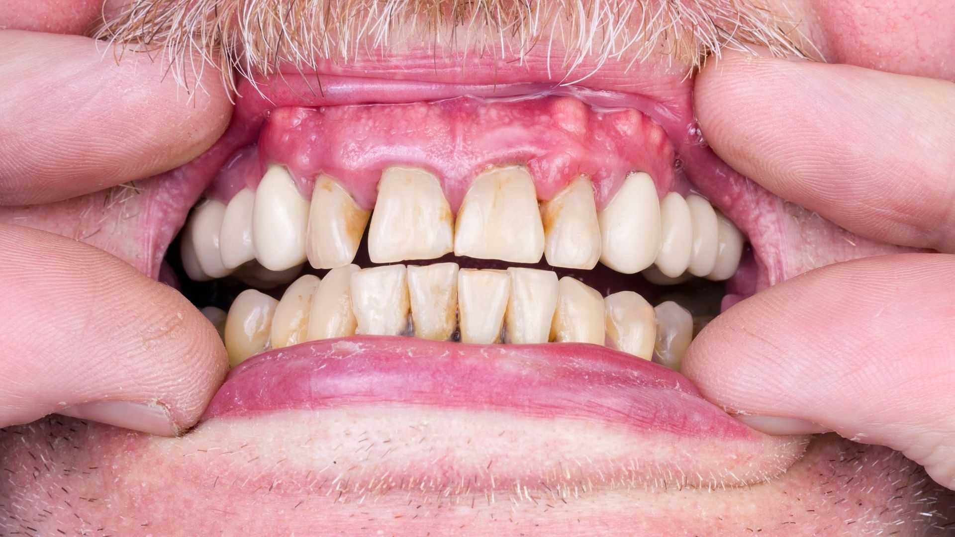 an image showing worn out teeth and gums Full Mouth Rehabilitation in Chandigarh