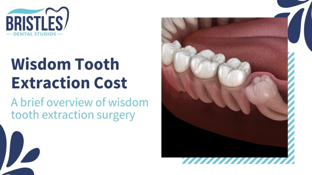A brief overview of wisdom tooth extraction: Wisdom Tooth Extraction Cost
