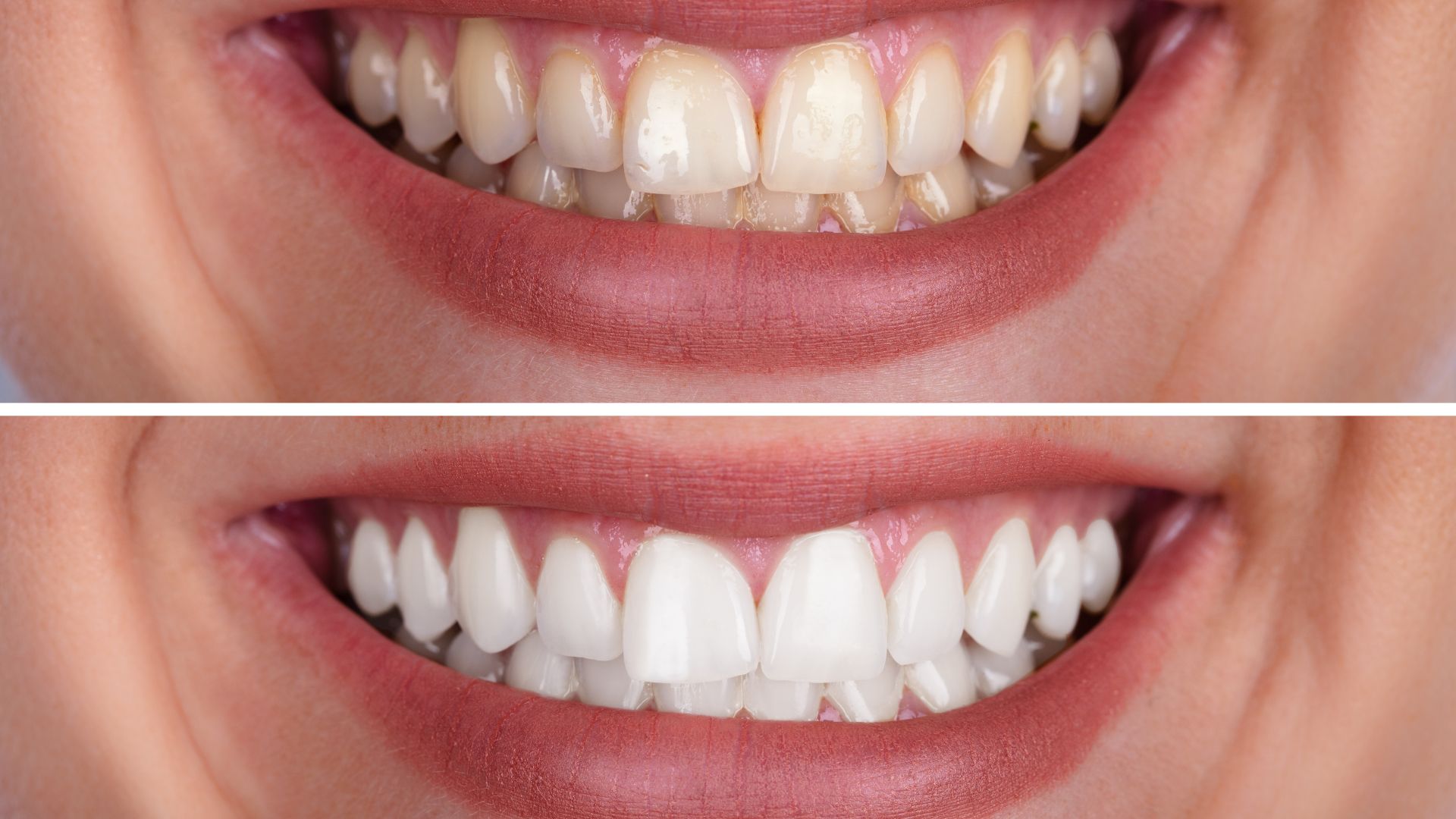 get Discoloured Teeth Treatment Chandigarh today