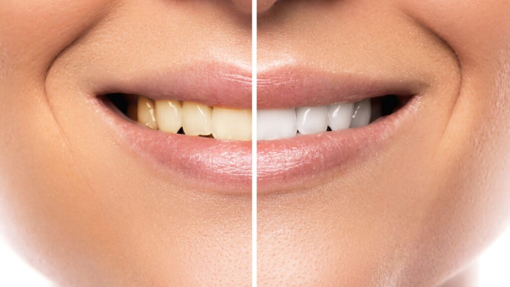 Discoloured Teeth Treatment Chandigarh - explore options today