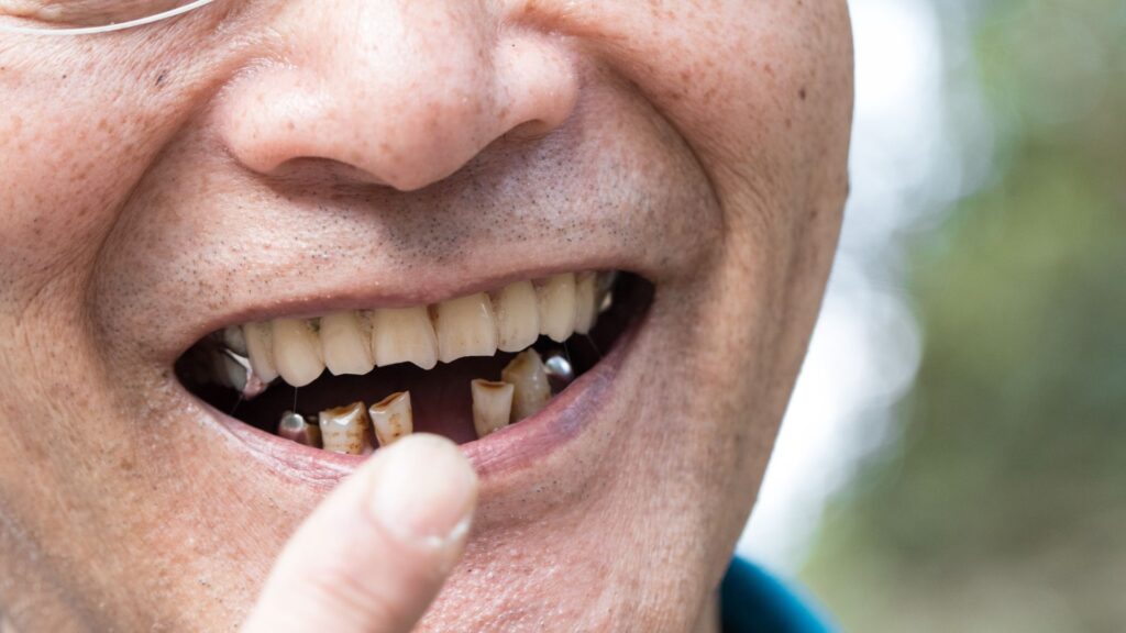 Replacement of Lost Teeth in Chandigarh