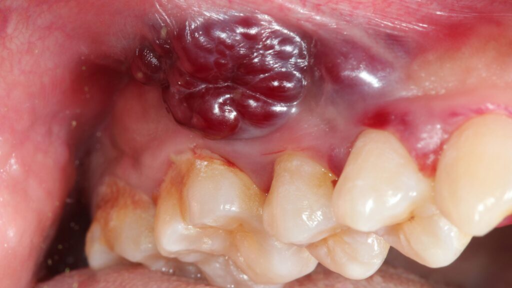 oral cancer treatment